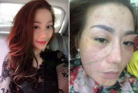 Cách trị mụn đầu đen, mụn cám trên mũi, thâm nám nặng - MSKH: TN15066